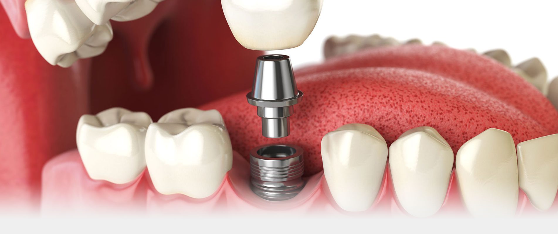 Implants Dental Implants Near You Teeth Transplant Karachi