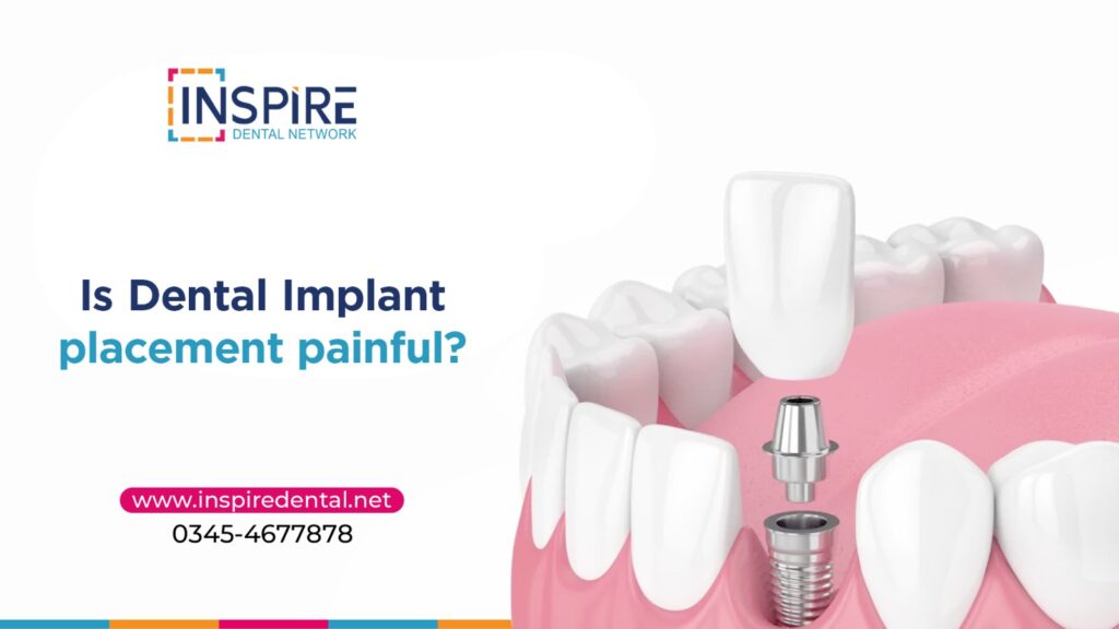 Is Dental Implant Placement Painful? What to Expect During and After Your Procedure